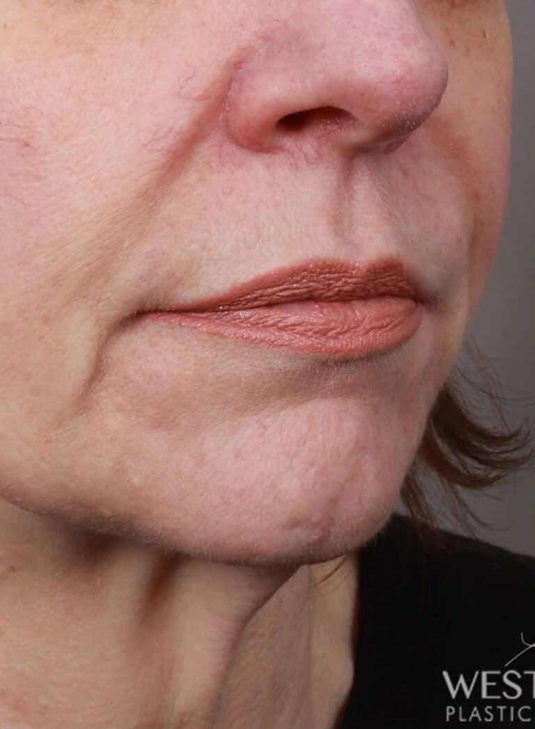 Before Image: Lip Lift (1.5 Months Post-Op) - right-front-oblique