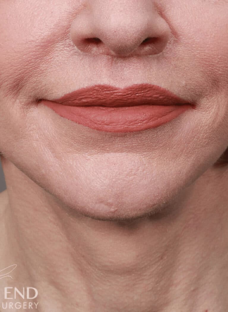 After Image: Lip Lift (1.5 Months Post-Op) - front