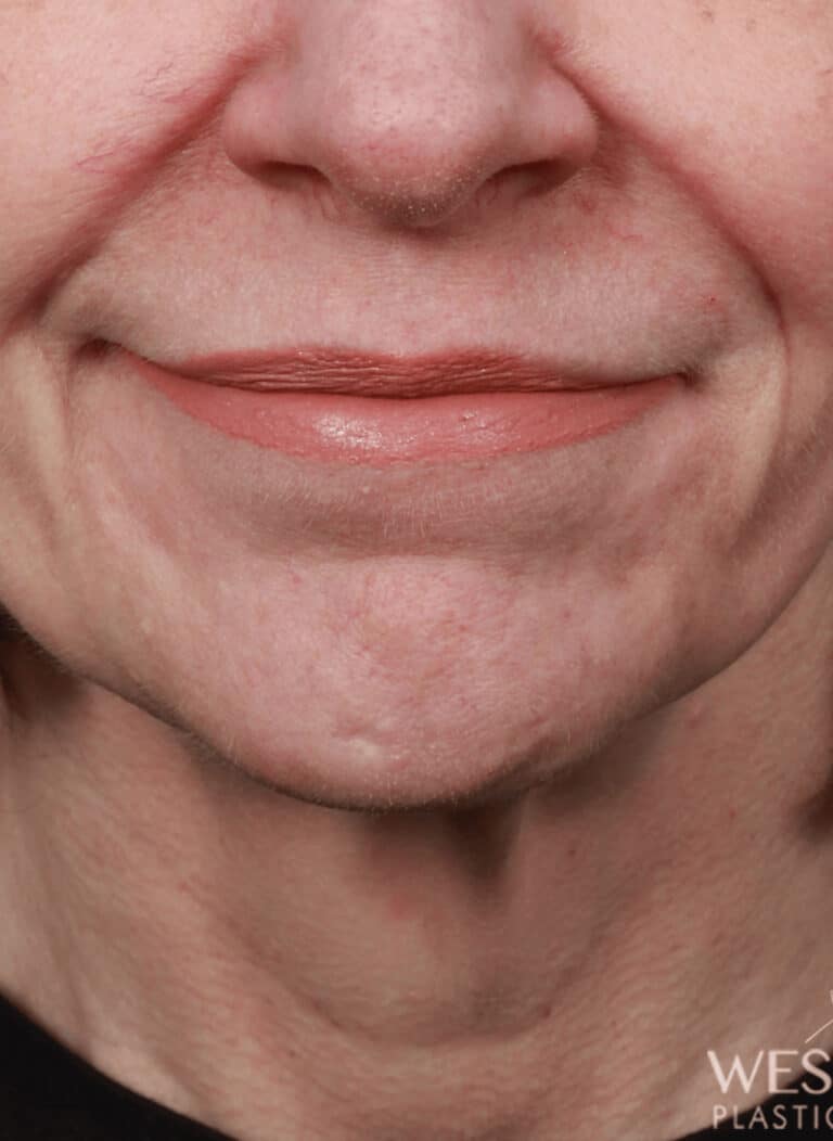 Before Image: Lip Lift (1.5 Months Post-Op) - front