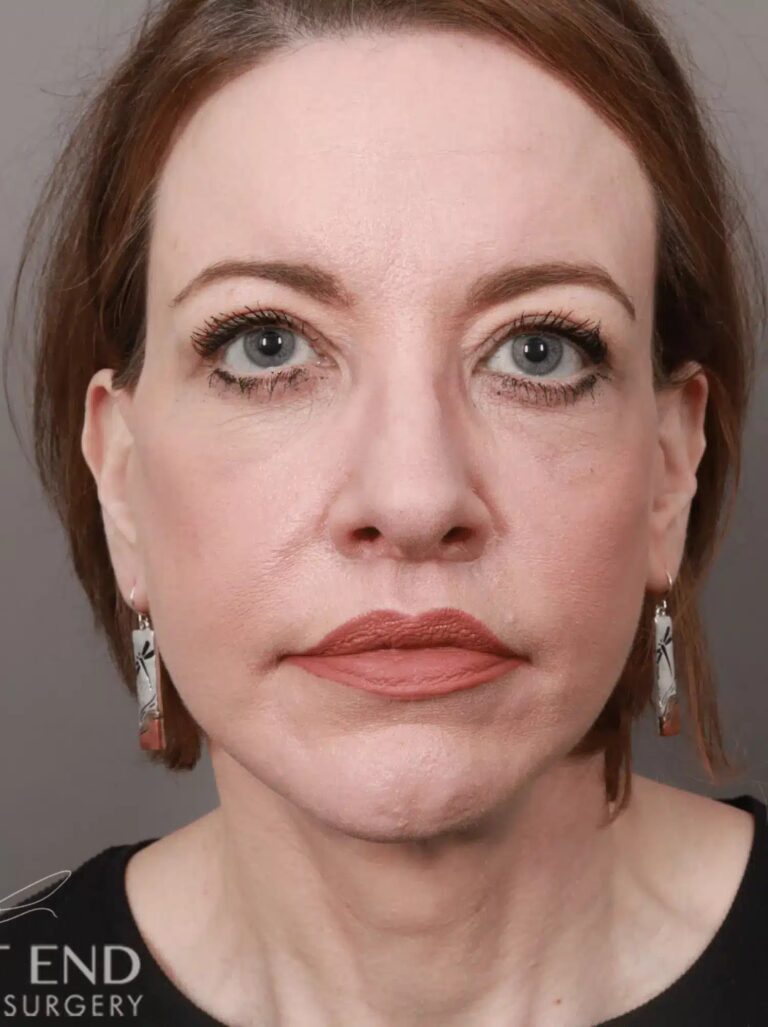 After Image: Lip Lift (1.5 Months Post-Op) - front