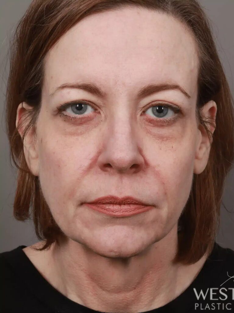 Before Image: Lip Lift (1.5 Months Post-Op) - front