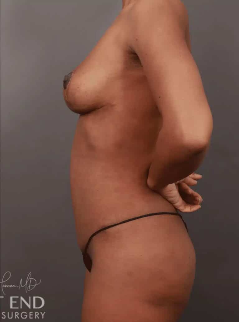 After Image: Mommy Makeover (Tummy Tuck, Breast Lift, & Liposuction) - left-side