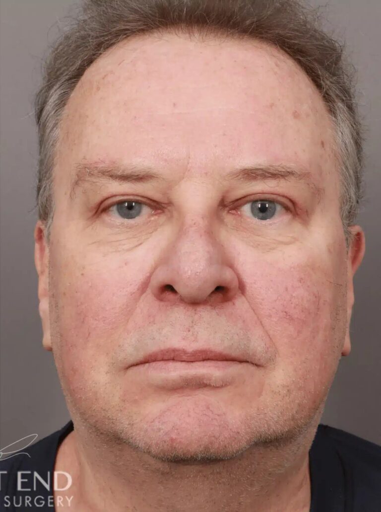 After Image: Upper Eyelid Lift & Brow Lift (2 weeks post-op) - front