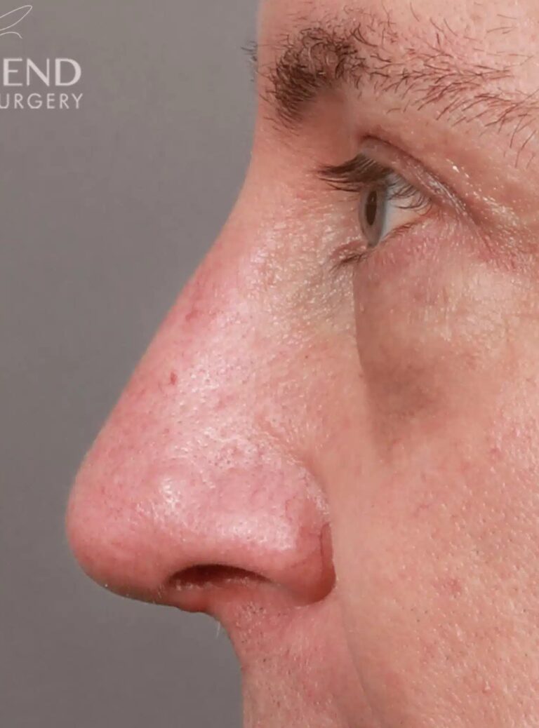 After Image: Open Septorhinoplasty with ClariFix (1 Month Post-Op) - left-side
