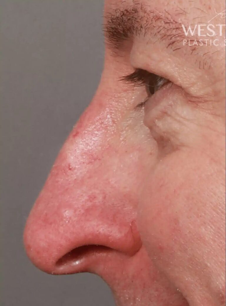 Before Image: Open Septorhinoplasty with ClariFix (1 Month Post-Op) - left-side
