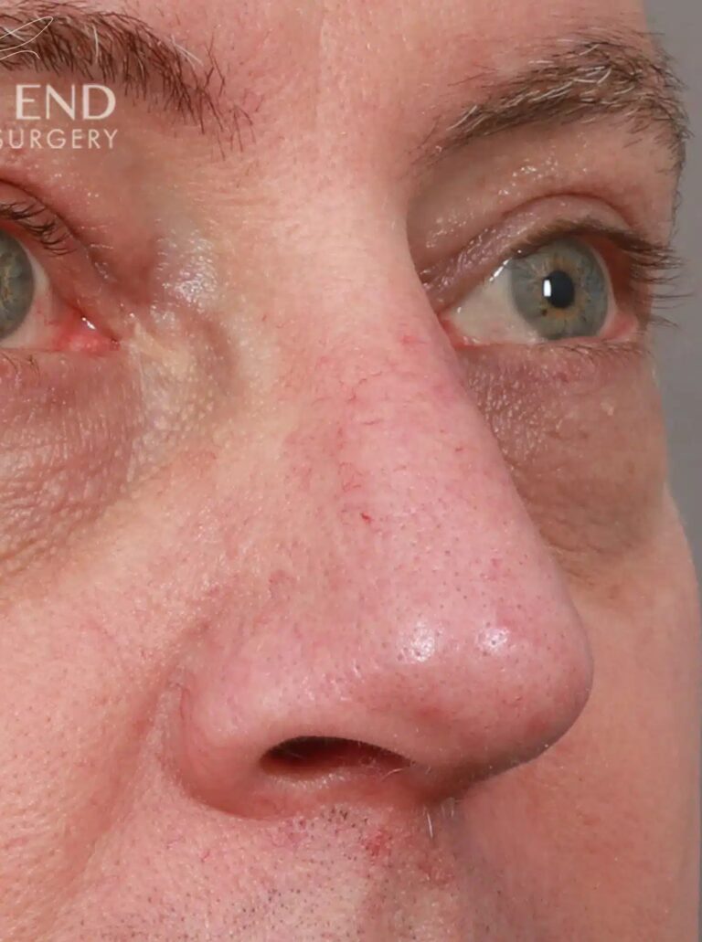After Image: Open Septorhinoplasty with ClariFix (1 Month Post-Op) - right-front-oblique