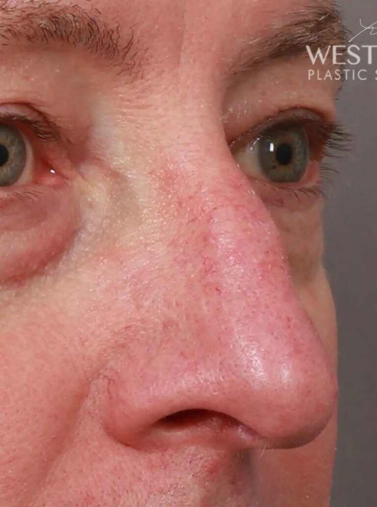 Before Image: Open Septorhinoplasty with ClariFix (1 Month Post-Op) - right-front-oblique