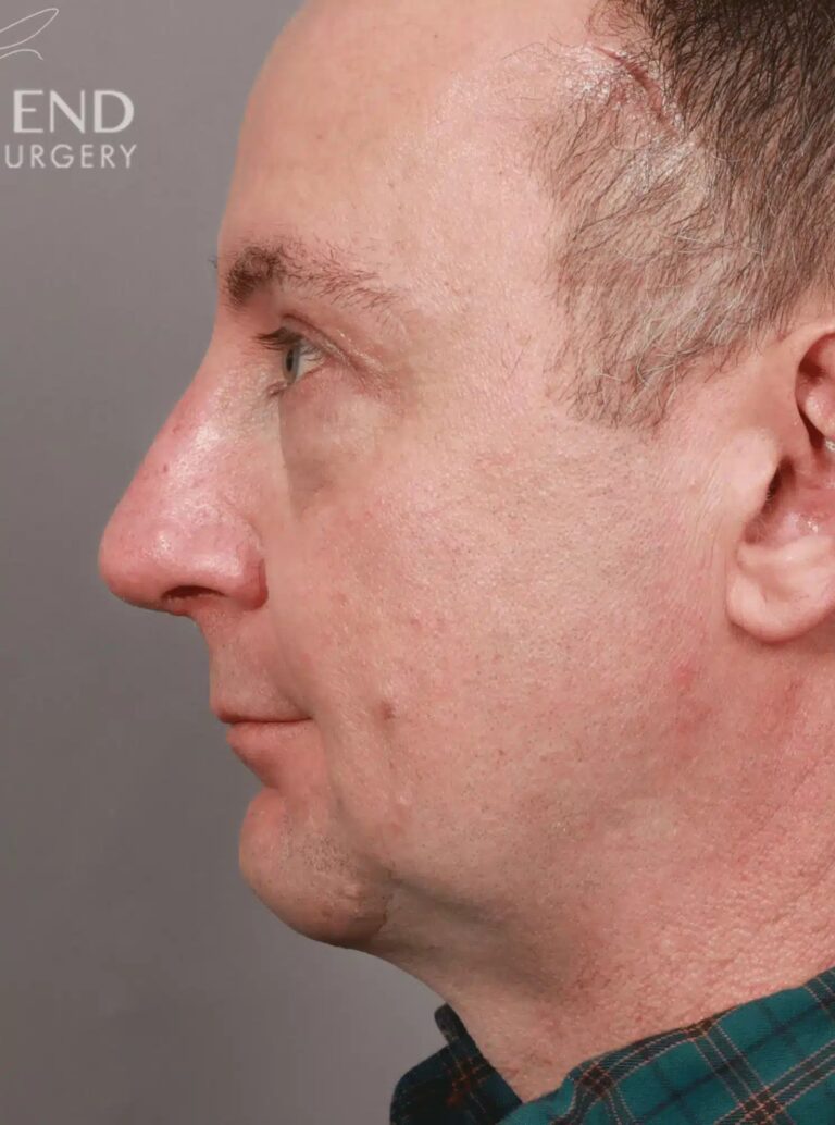 After Image: Open Septorhinoplasty with ClariFix (1 Month Post-Op) - left-side