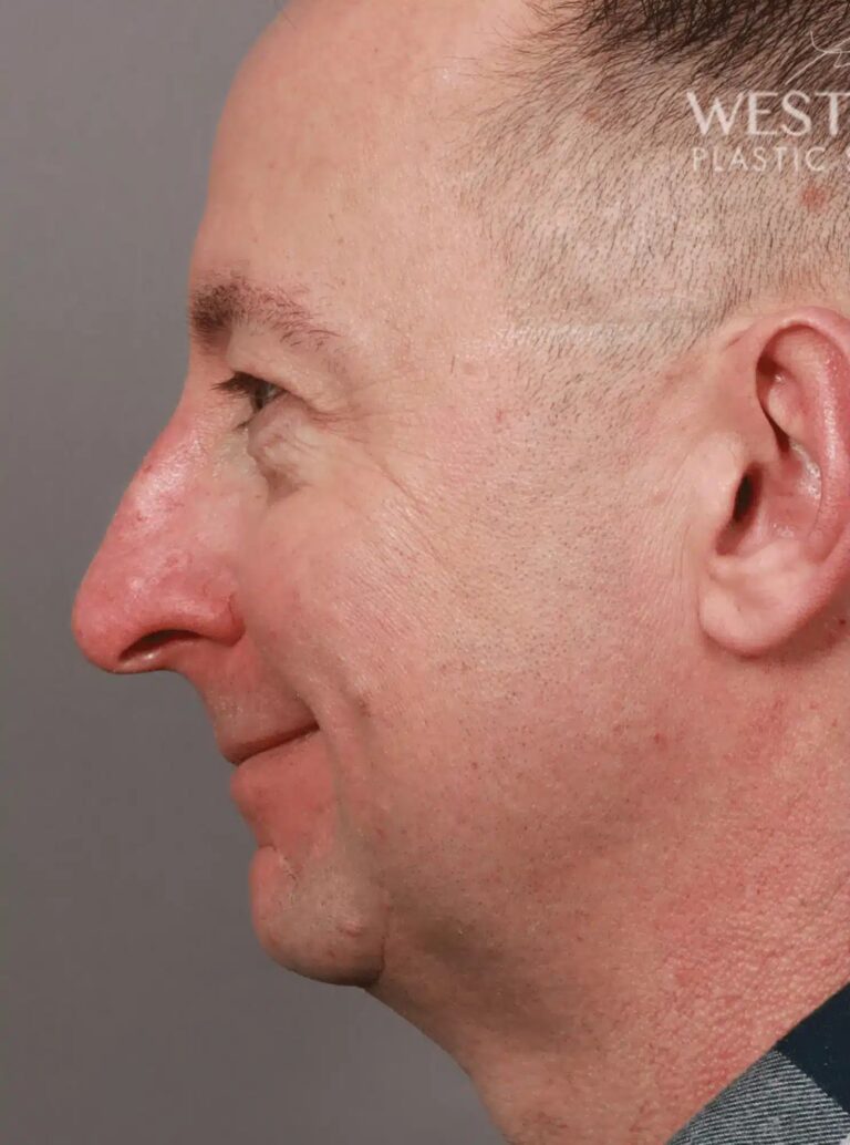 Before Image: Open Septorhinoplasty with ClariFix (1 Month Post-Op) - left-side