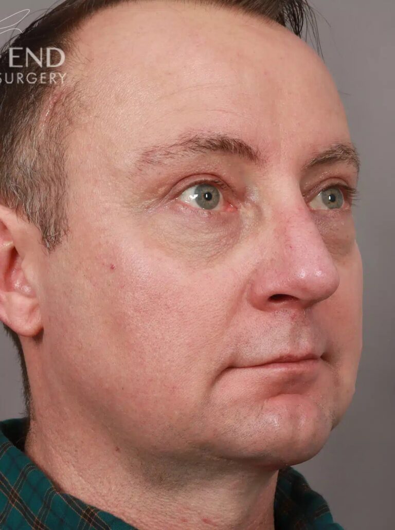 After Image: Open Septorhinoplasty with ClariFix (1 Month Post-Op) - right-front-oblique