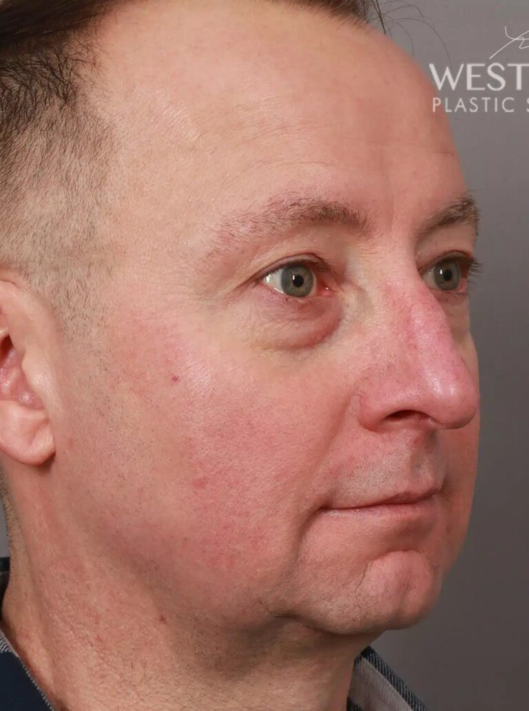 Before Image: Open Septorhinoplasty with ClariFix (1 Month Post-Op) - right-front-oblique