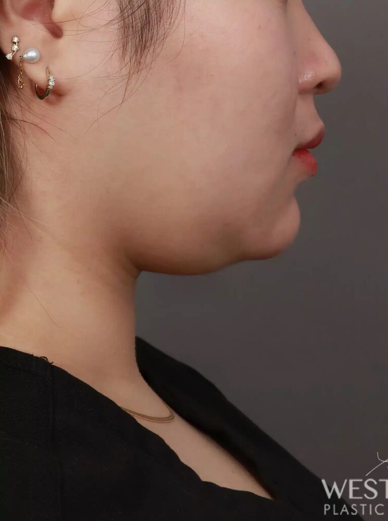 Before Image: Liposuction of the Submental, Jawline, and Neck Region (2 Weeks Post-Op) - right-side