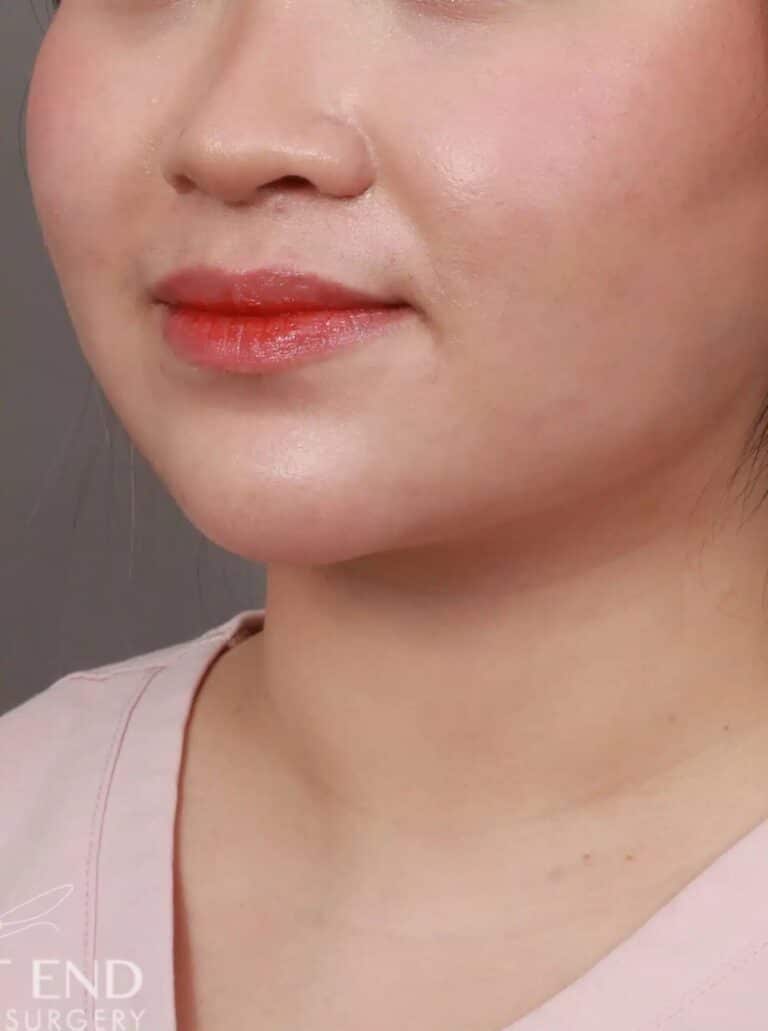 After Image: Liposuction of the Submental, Jawline, and Neck Region (2 Weeks Post-Op) - left-front-oblique