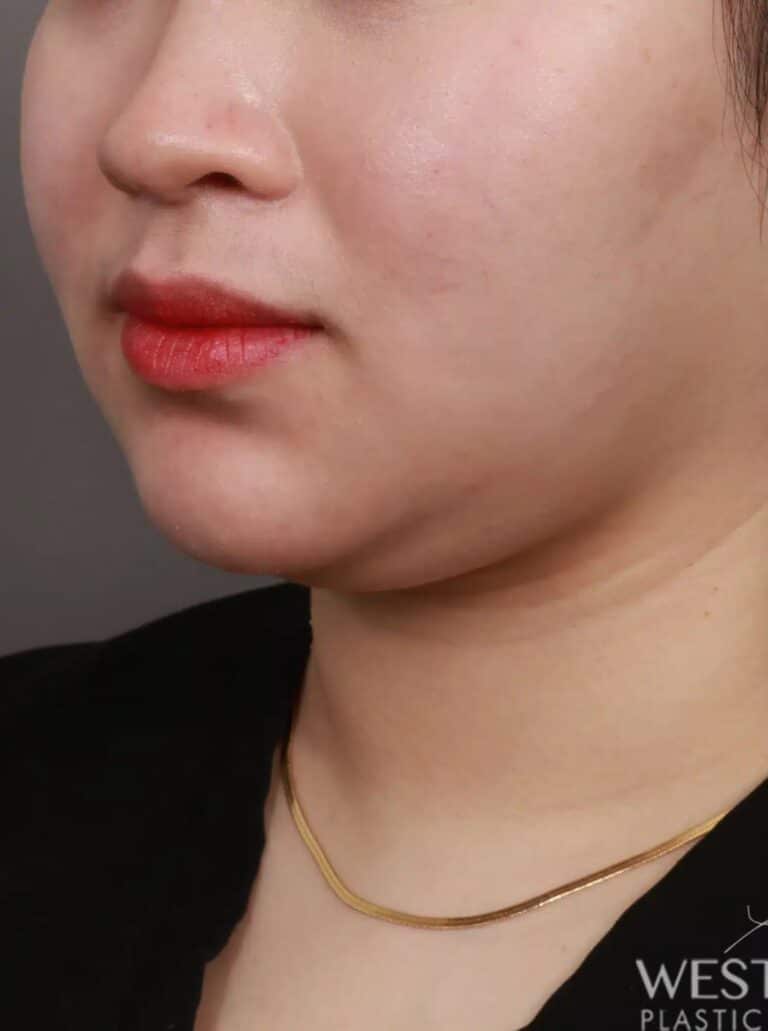 Before Image: Liposuction of the Submental, Jawline, and Neck Region (2 Weeks Post-Op) - left-front-oblique