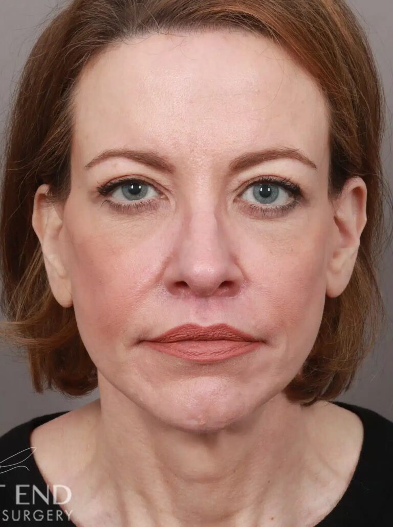 After Image: Deep Plane Facelift & Neck Lift, Lip Lift, Eyelid Lift, Brow Lift, Fat Grafting, and CO2 Resurfacing (3.5 Months Post-Op) - front