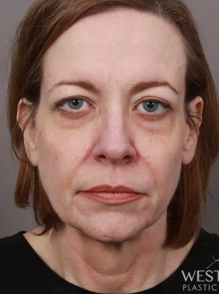 Before Image: Deep Plane Facelift & Neck Lift, Lip Lift, Eyelid Lift, Brow Lift, Fat Grafting, and CO2 Resurfacing (3.5 Months Post-Op) - front