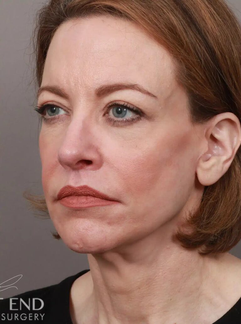 After Image: Deep Plane Facelift & Neck Lift, Lip Lift, Eyelid Lift, Brow Lift, Fat Grafting, and CO2 Resurfacing (3.5 Months Post-Op) - left-front-oblique