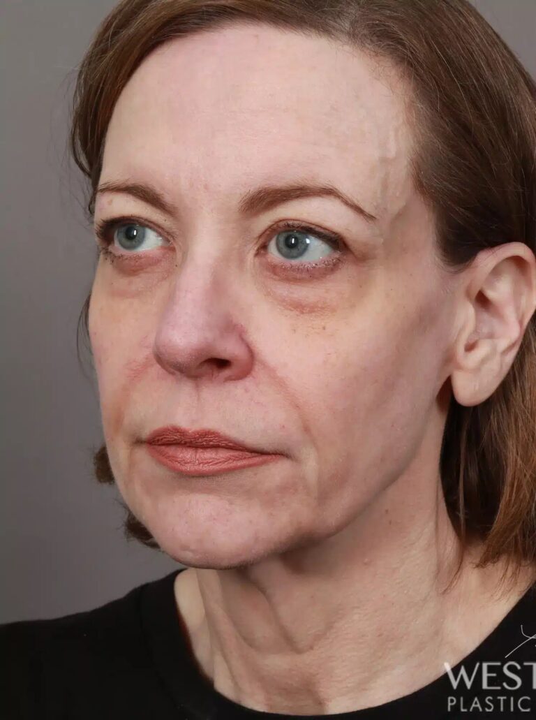 Before Image: Deep Plane Facelift & Neck Lift, Lip Lift, Eyelid Lift, Brow Lift, Fat Grafting, and CO2 Resurfacing (3.5 Months Post-Op) - left-front-oblique