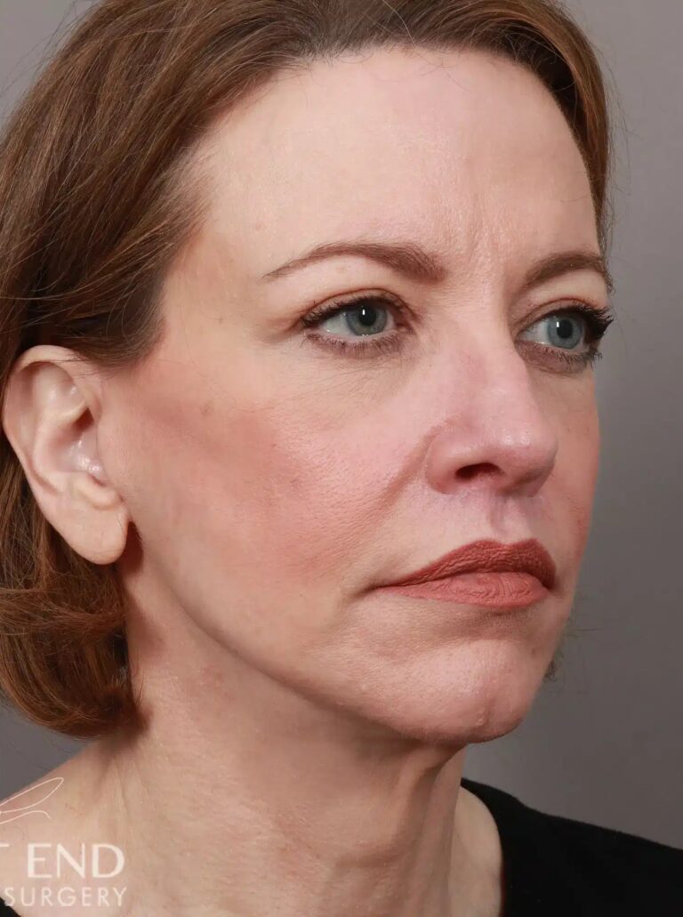 After Image: Deep Plane Facelift & Neck Lift, Lip Lift, Eyelid Lift, Brow Lift, Fat Grafting, and CO2 Resurfacing (3.5 Months Post-Op) - right-front-oblique