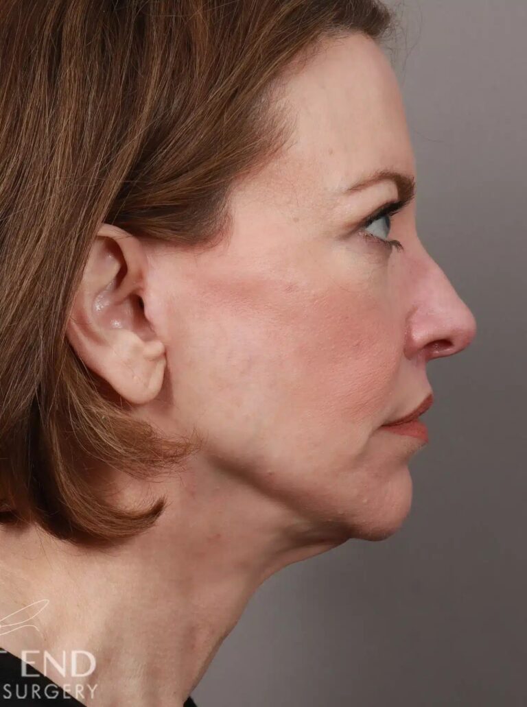 After Image: Deep Plane Facelift & Neck Lift, Lip Lift, Eyelid Lift, Brow Lift, Fat Grafting, and CO2 Resurfacing (3.5 Months Post-Op) - right-side