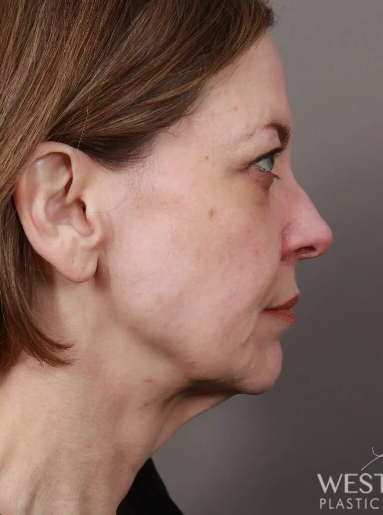 Before Image: Deep Plane Facelift & Neck Lift, Lip Lift, Eyelid Lift, Brow Lift, Fat Grafting, and CO2 Resurfacing (3.5 Months Post-Op) - right-side