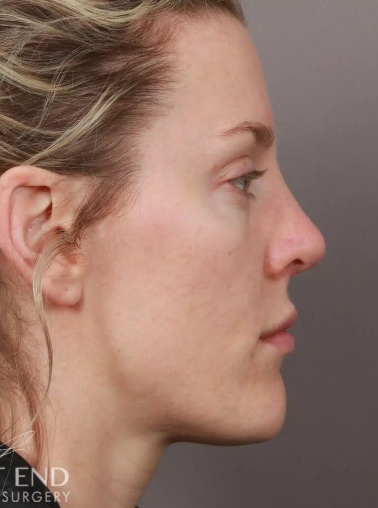 After Image: Rhinoplasty (4.5 Months Post-Op) - right-side