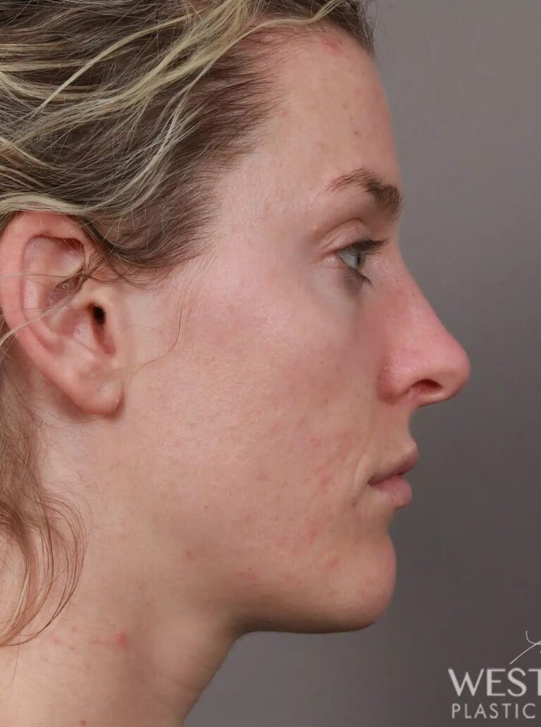 Before Image: Rhinoplasty (4.5 Months Post-Op) - right-side