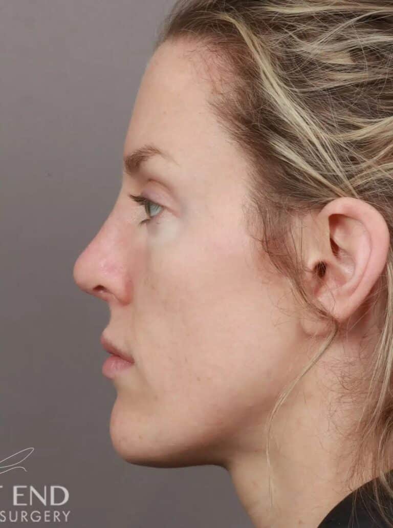 After Image: Rhinoplasty (4.5 Months Post-Op) - left-side
