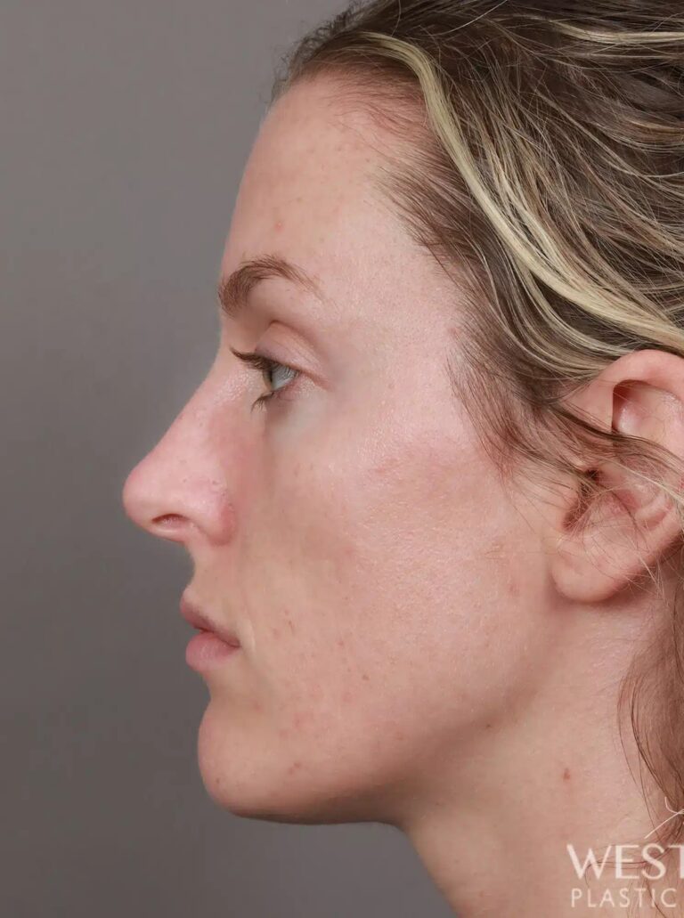 Before Image: Rhinoplasty (4.5 Months Post-Op) - left-side