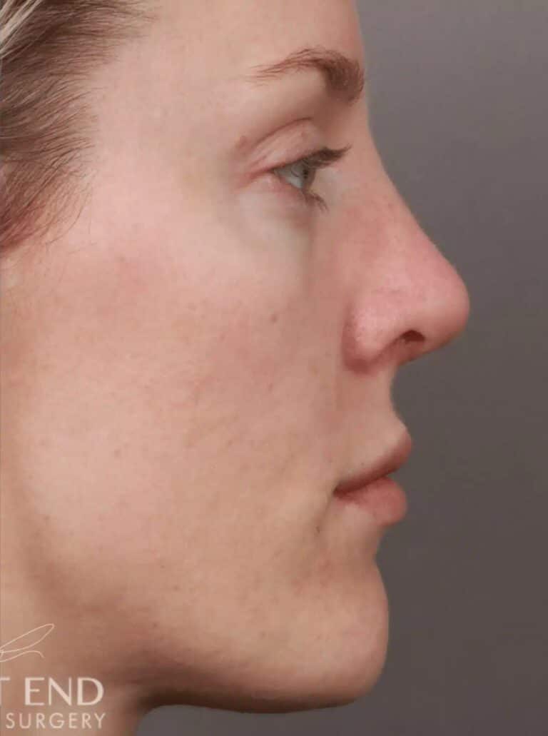 After Image: Rhinoplasty (4.5 Months Post-Op) - right-side