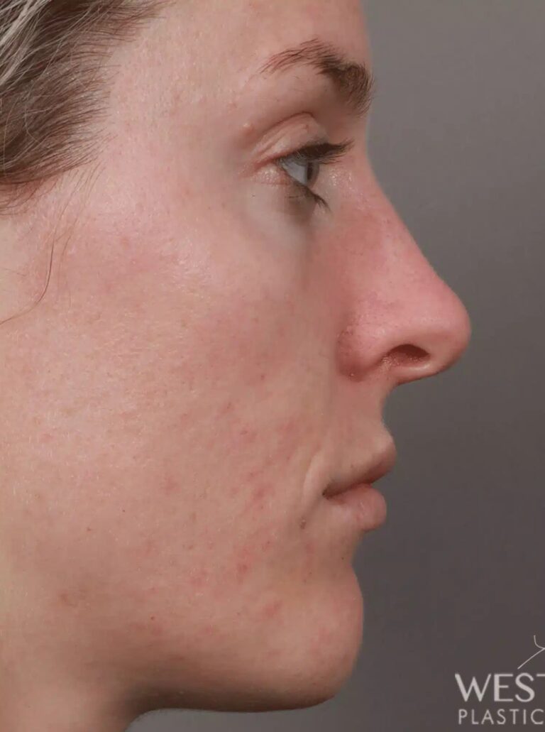 Before Image: Rhinoplasty (4.5 Months Post-Op) - right-side