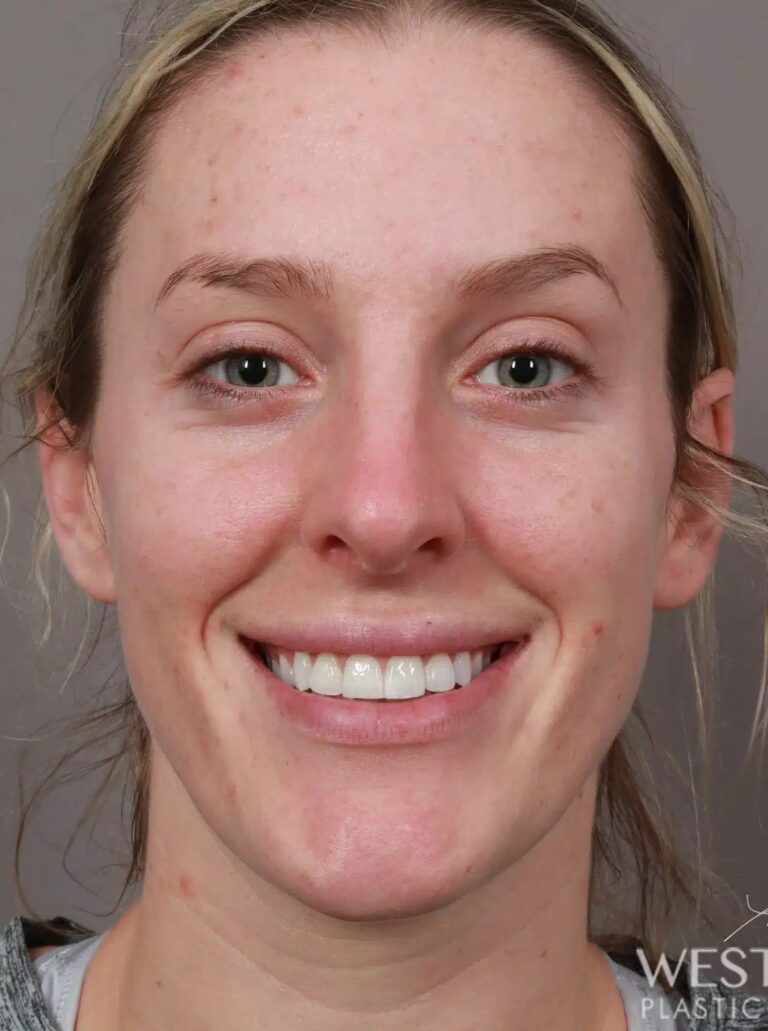 Before Image: Rhinoplasty (4.5 Months Post-Op) - front