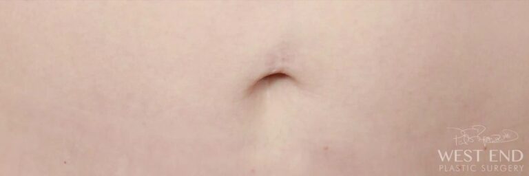 After Image: Umbilicoplasty (Fat Grafting to Belly Button) - front