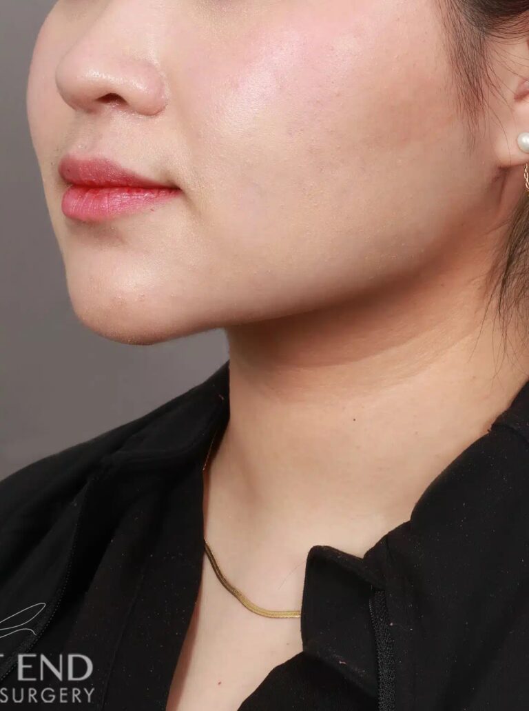 After Image: Liposuction of the Submental, Jawline, and Neck Region (3 Months Post-Op) - left-front-oblique