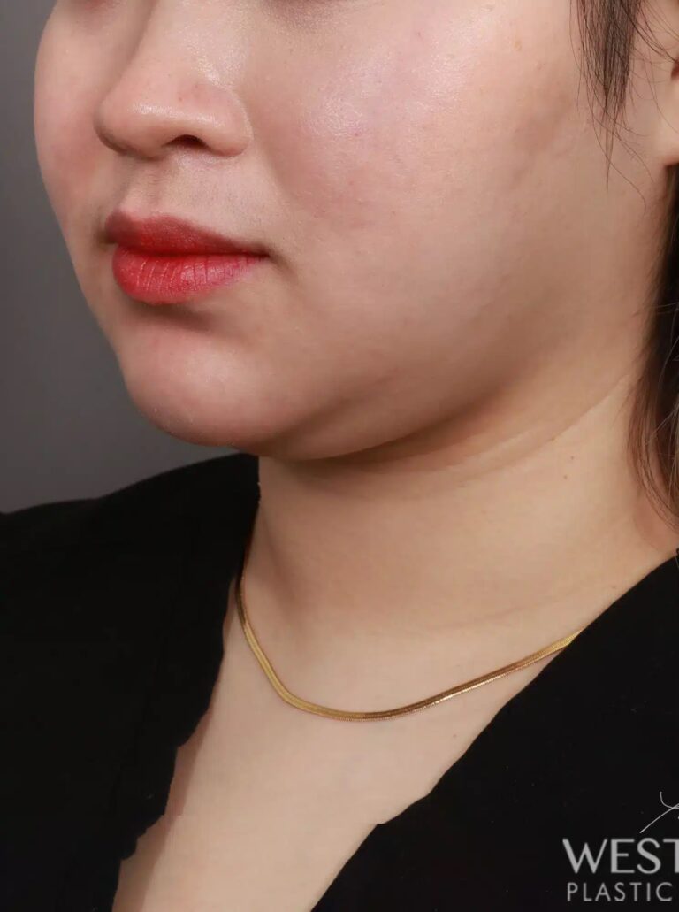 Before Image: Liposuction of the Submental, Jawline, and Neck Region (3 Months Post-Op) - left-front-oblique