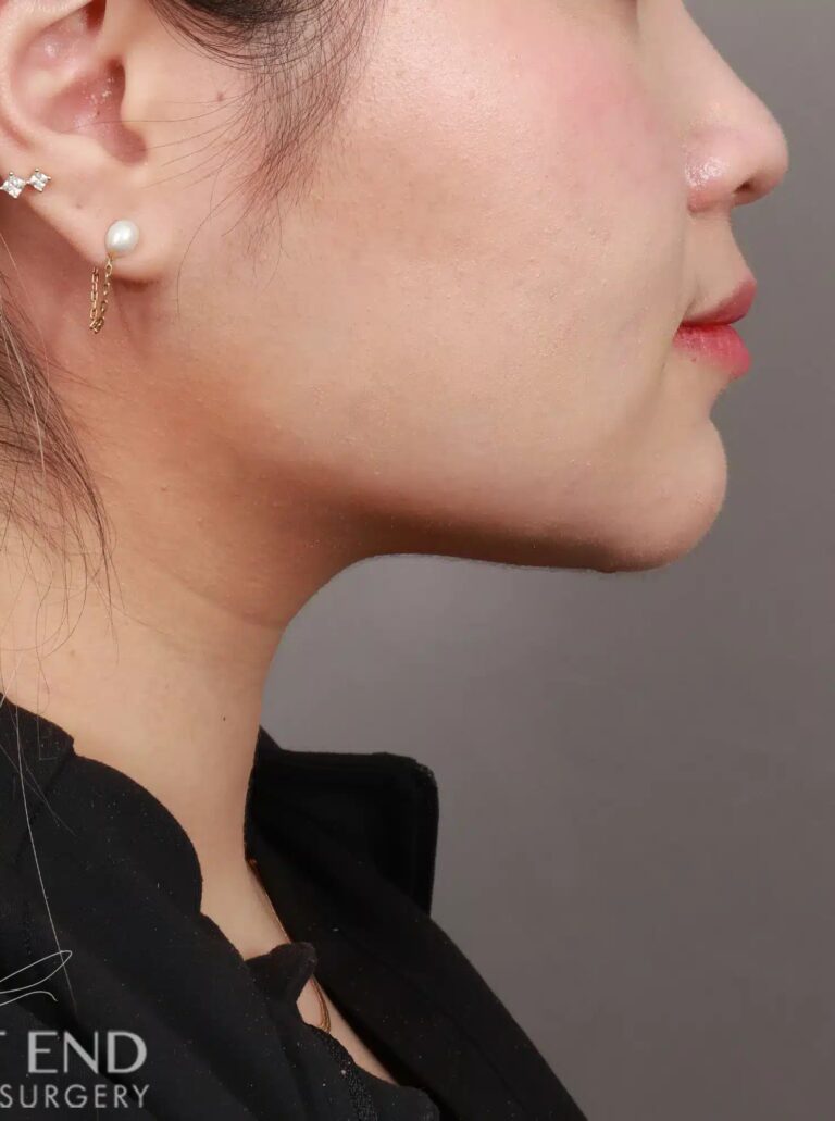 After Image: Liposuction of the Submental, Jawline, and Neck Region (3 Months Post-Op) - right-front-oblique