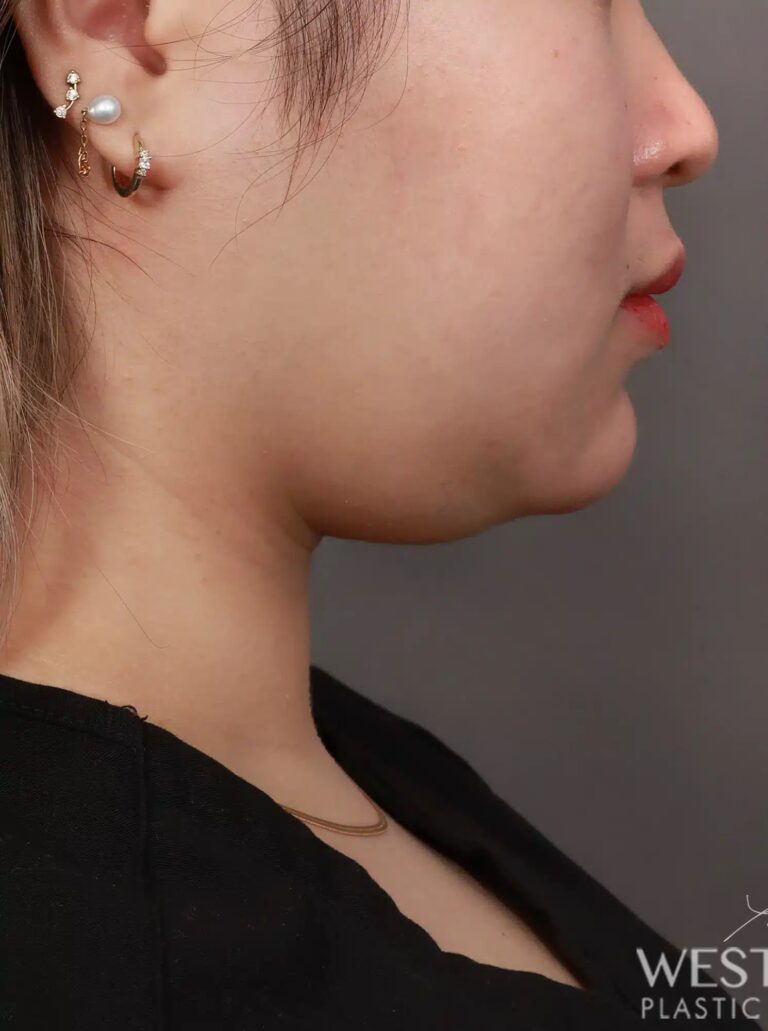 Before Image: Liposuction of the Submental, Jawline, and Neck Region (3 Months Post-Op) - right-front-oblique