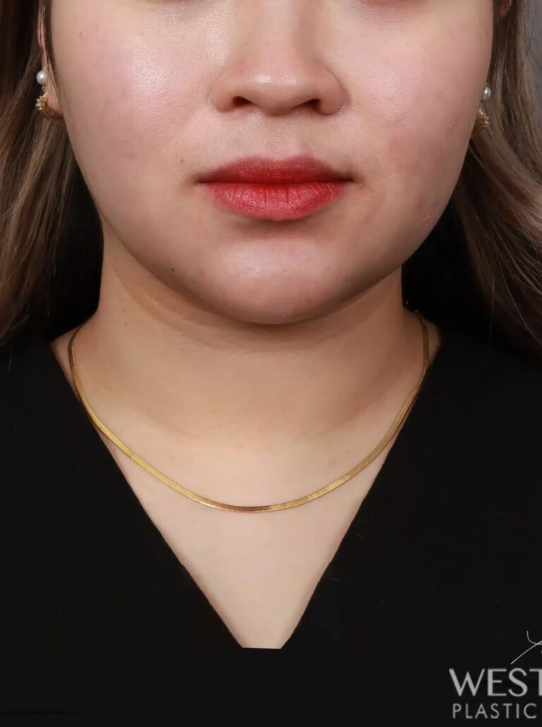 Before Image: Liposuction of the Submental, Jawline, and Neck Region (3 Months Post-Op) - front