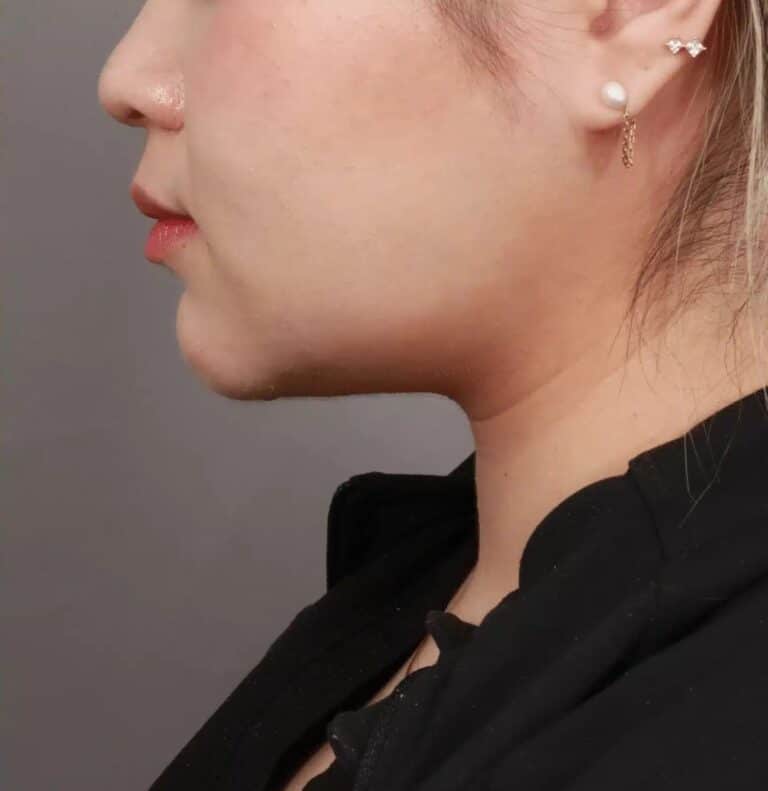 After Image: Liposuction of the Submental, Jawline, and Neck Region (3 Months Post-Op) - left-side
