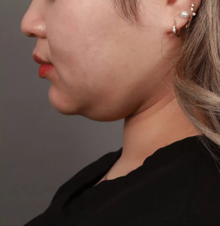 Before Image: Liposuction of the Submental, Jawline, and Neck Region (3 Months Post-Op) - left-side