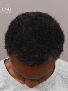 After Image: NeoGraft Hair Restoration (1 Year Post-op)