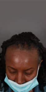 Before Image: NeoGraft Hair Restoration (1 Year Post-op)