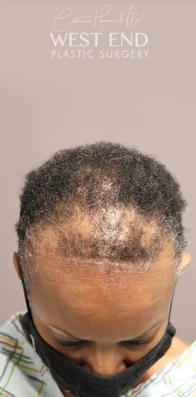 Before Image: NeoGraft Hair Restoration (1 Year Post-op) - front