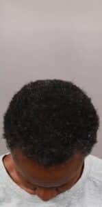 After Image: NeoGraft Hair Restoration (1 Year Post-op)