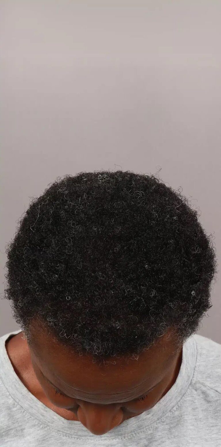 After Image: NeoGraft Hair Restoration (1 Year Post-op) -