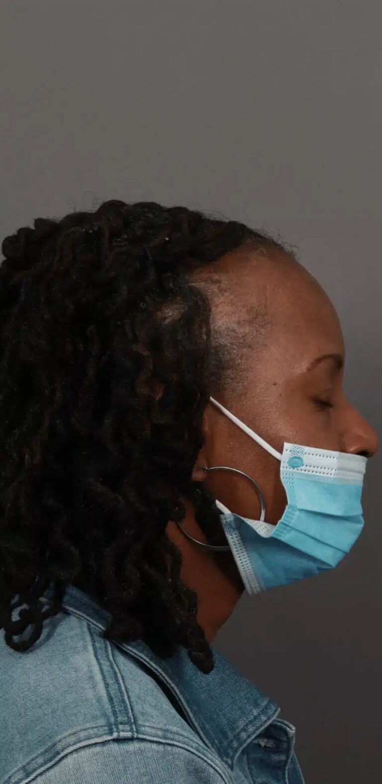 Before Image: NeoGraft Hair Restoration (1 Year Post-op) -