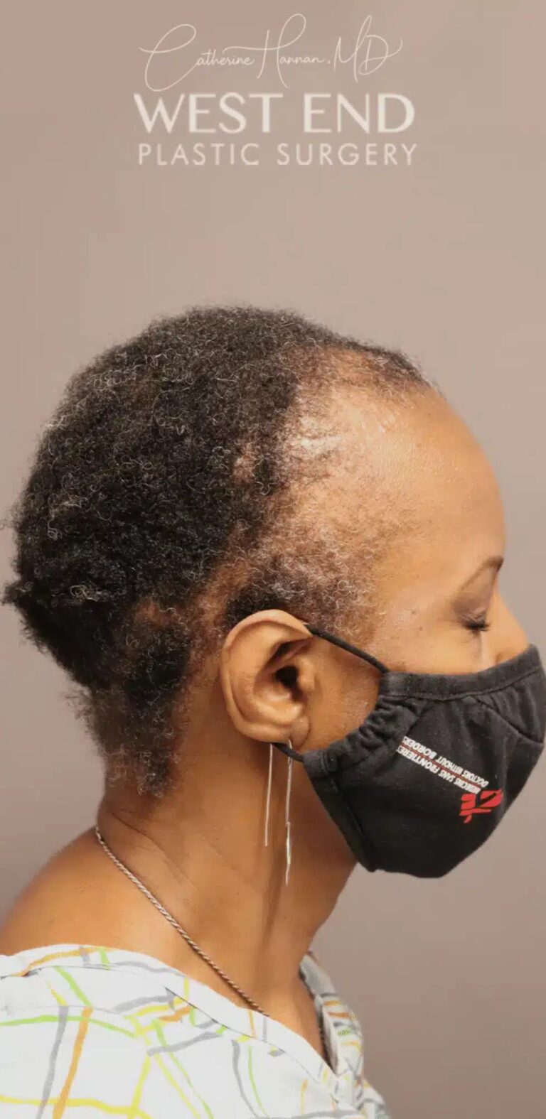 Before Image: NeoGraft Hair Restoration (1 Year Post-op) - right-side