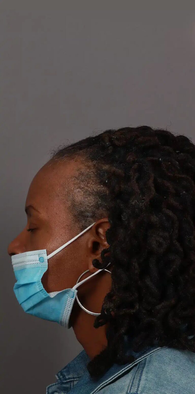 Before Image: NeoGraft Hair Restoration (1 Year Post-op) -