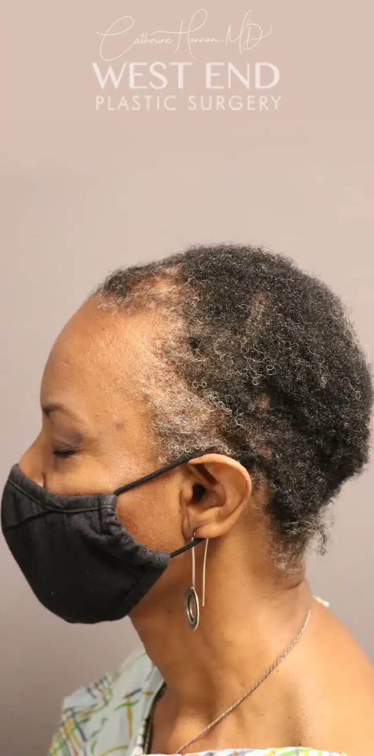 Before Image: NeoGraft Hair Restoration (1 Year Post-op) - left-side