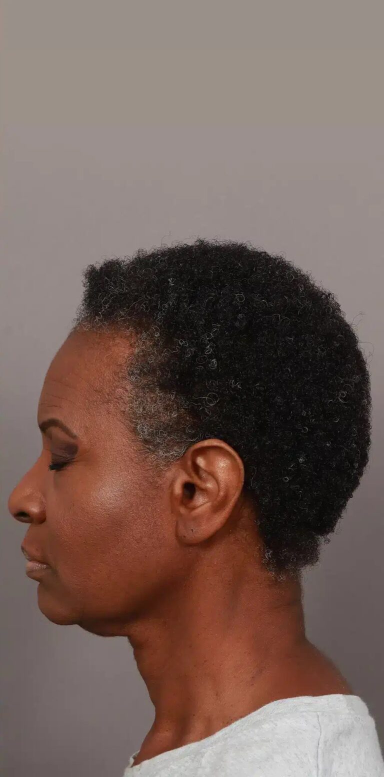 After Image: NeoGraft Hair Restoration (1 Year Post-op) -
